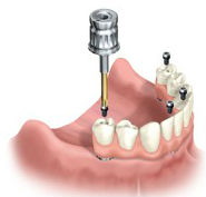diagram-of-how-all-on-four-dental-implants-are-attached