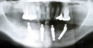 x-ray-of-all-on-four-dental-implants
