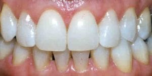 teeth-after-bleaching
