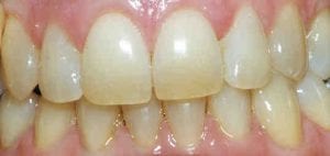teeth-before-teeth-bleaching