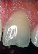 photo-of-chipped-tooth-before-dental-bonding