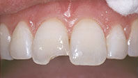 dental-bonding-chip-before