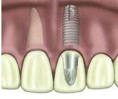 illustration-of-a-dental-implant-near-natural-teeth