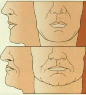 diagram-of-facial-collapse