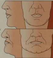 diagram-of-facial-collapse