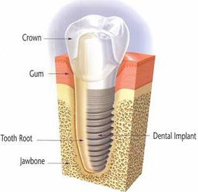 diagram-of-huntsville-dental-implant