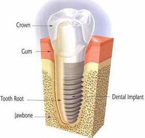diagram-of-huntsville-dental-implant