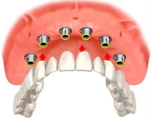 drawing-of-implant-overdenture-with-six-implants