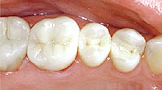 photo-of-mercury-free-dentist-filling-after