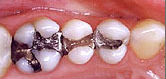 photo-of-mercury-free-dentist-filling-before