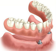 drawing-of-snap-on-denture