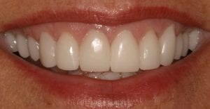 photo-of-teeth-after-all-porcelain-crowns