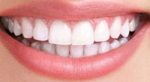 photo-of-teeth-after-teeth-whitening