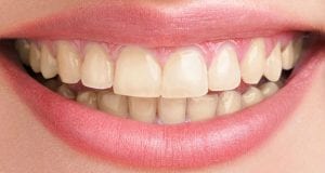 photo-of-teeth-before-teeth-whitening