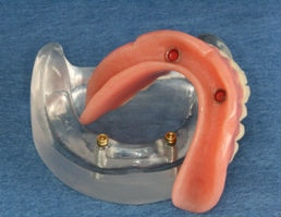 snap-on-denture-supported-by-two-implants