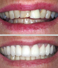photos-showing-zirconia-crowns-before-and-after