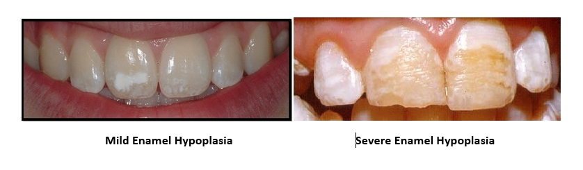 Image showing two types of enamel hypoplasia, mild and severe