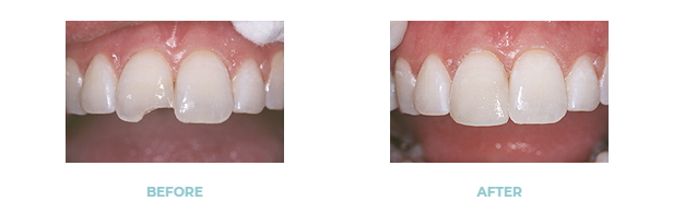An image showing before and after of dental bonding