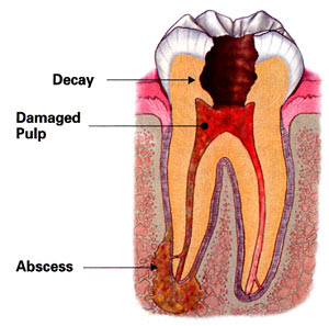 Root canal treatment illustration
